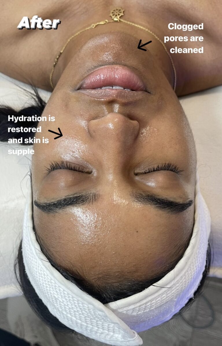 HydraFacial Toronto, Toronto HydraFacial, HydraFacial Near Me, Best HydraFacial Toronto, Luxury Facial Toronto, Facial Treatment Toronto, Glowing Skin Toronto, Radiance Facial Toronto, Age Rewind Facial, Hydrating Facial Toronto, Deep Cleansing Facial, Medical Facial Toronto, Anti Aging Facial Toronto, Skincare Toronto, Facial Spa Toronto, Spa Toronto, Toronto Wellness Spa, Luxury Spa Toronto, Body Sculpt Massage Toronto, Lymphatic Massage Toronto, Lymphatic Drainage Massage Toronto, Body Contouring Toronto, Sculpting Massage Toronto, Reduce Bloating Toronto, Water Retention Treatment Toronto, Detox Massage Toronto, Wellness Massage Toronto, Skin Rejuvenation Toronto, Brightening Facial Toronto, Pore Cleansing Facial Toronto, Healthy Skin Toronto, Facial Clinic Toronto, Beauty Spa Toronto, Skin Hydration Toronto, Toronto Aesthetic Spa, Skin Glow Treatment Toronto, Female Owned Business Toronto, Toronto Facial Specialist, Toronto Massage Spa, Non Invasive Body Sculpting Toronto, Kensington Market Spa, Downtown Toronto Facial, Toronto Self Care, Luxury Wellness Toronto, Radiant Skin Toronto, Skin Renewal Toronto, Custom Facial Toronto, Facial Boutique Toronto, Premium Spa Toronto.